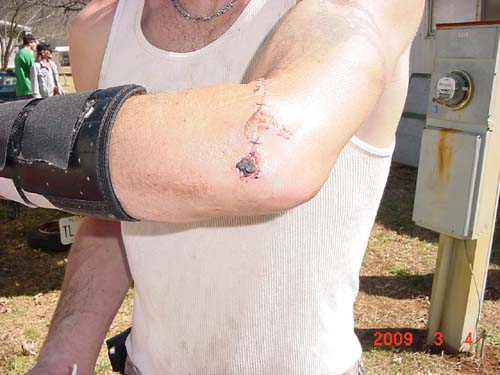 chain saw injury 03a
chain saw injury 03a - tree climber without protective gear

Keywords: chain saw injury  tree climber without protective gear